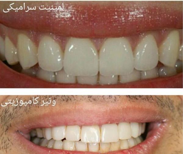 کامپوزیت و لمینت دندان چه تفاوتی دارند؟